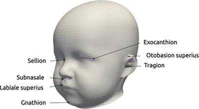 Impact of data synthesis strategies for the classification of craniosynostosis